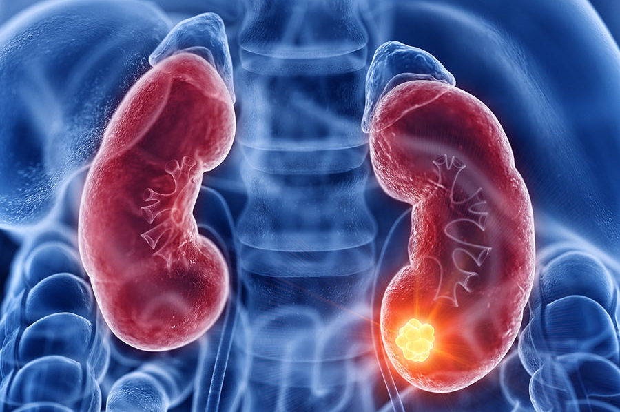 Más 3,000 muertes año a causa Cáncer Renal